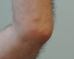 Erythema Nodosum